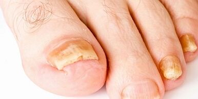 Wie und wie man Nagelpilz heilt