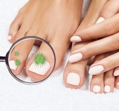 Nagelinfektion durch einen Lupe