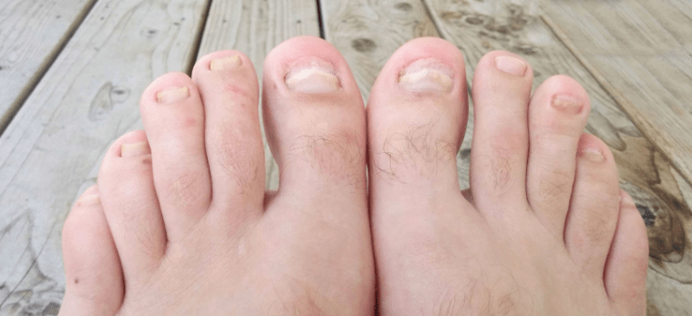 Nagelpilz