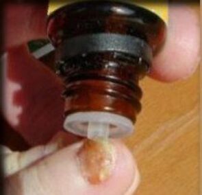 Auftragen von Tropfen auf einen von Pilzen befallenen Zehennagel